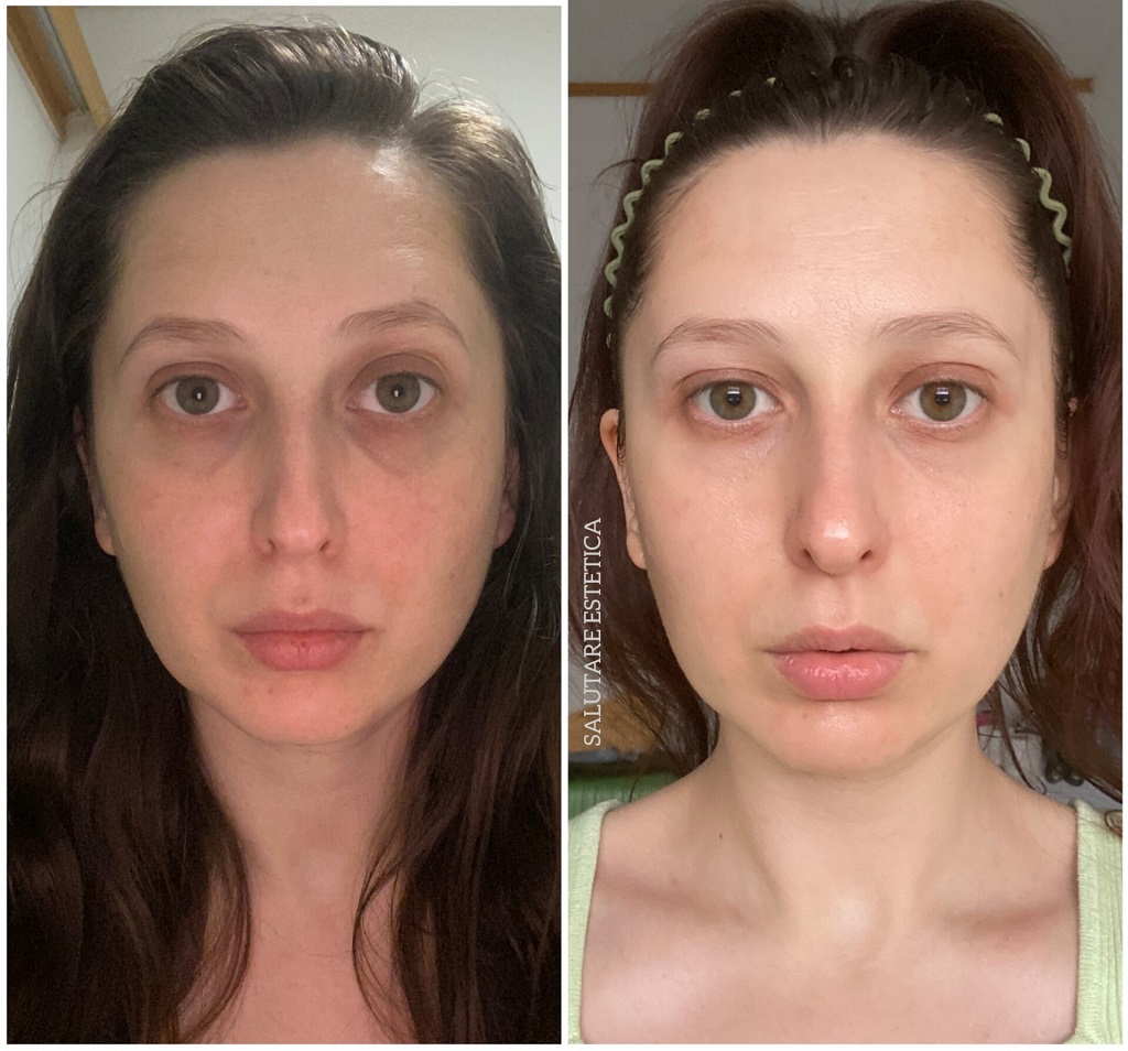 Підтяжка обличчя, Ліфтинг